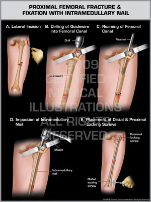 Exhibit of Proximal Femoral Fracture & Fixation with Intramedullary Nail. Exhibit of Proximal Femoral Fracture & Fixation with Intramedullary Nail.