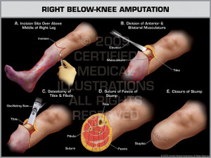 Exhibit of Right Below-Knee Amputation.