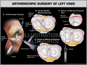 Exhibit of Arthroscopic Surgery of Left Knee 1