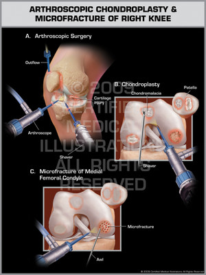 Arthroscopic Chondroplasty & Microfracture of Right Knee