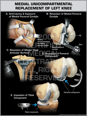 Medial Unicompartmental Replacement of Left Knee