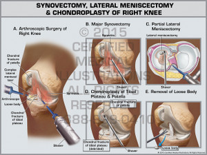 Synovectomy, Lateral Meniscectomy & Chondroplasty of Right Knee Synovectomy, Lateral Meniscectomy & Chondroplasty of Right Knee