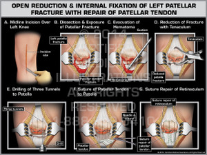 Open Reduction & Internal Fixation of Left Patellar Fracture with Repair of Patellar Tendon Open Reduction & Internal Fixation of Left Patellar Fracture with Repair of Patellar Tendon