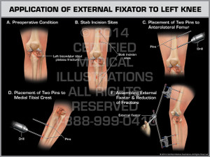 Exhibit of Application of External Fixator to Left Knee. Exhibit of Application of External Fixator to Left Knee.