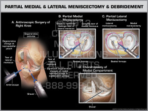 Exhibit of Partial Medial & Lateral Meniscectomy & Debridement. Exhibit of Partial Medial & Lateral Meniscectomy & Debridement.
