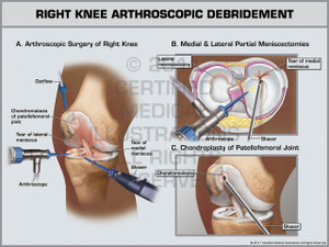 Exhibit of Right Knee Arthroscopic Debridement. Exhibit of Right Knee Arthroscopic Debridement.