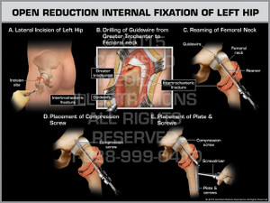 Exhibit of Open Reduction Internal Fixation of Left Hip.