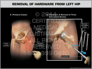 Exhibit of Removal of Hardware from Left Hip. Exhibit of Removal of Hardware from Left Hip.