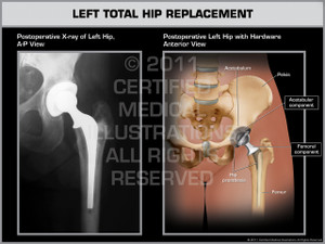 Exhibit of Left Total Hip Replacement. Exhibit of Left Total Hip Replacement.