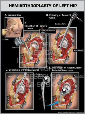 Exhibit of Hemiarthroplasty of Left Hip. Exhibit of Hemiarthroplasty of Left Hip.