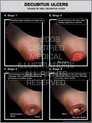 Exhibit of Decubitus Ulcers - Stages of Heel Decubitus Ulcer. Exhibit of Decubitus Ulcers - Stages of Heel Decubitus Ulcer.