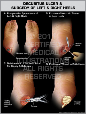 Exhibit of Decubitus Ulcer & Surgery of Left & Right Heels. Exhibit of Decubitus Ulcer & Surgery of Left & Right Heels.
