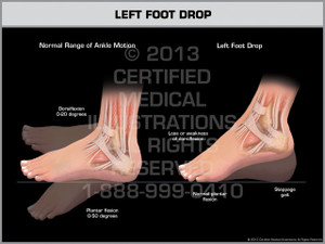 Exhibit of Left Foot Drop. Exhibit of Left Foot Drop.