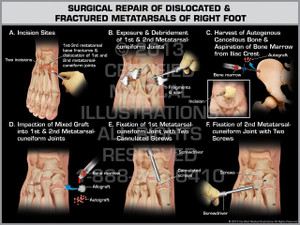 Exhibit of Surgical Repair of Dislocated & Fractured Metatarsals of Right Foot. Exhibit of Surgical Repair of Dislocated & Fractured Metatarsals of Right Foot.