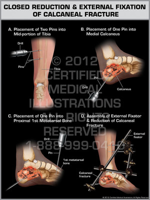 Exhibit of Closed Reduction & External Fixation of Calcaneal Fracture. Exhibit of Closed Reduction & External Fixation of Calcaneal Fracture.