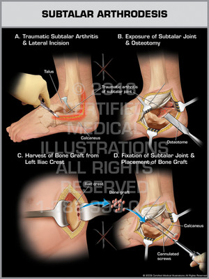 Exhibit of Subtalar Arthrodesis.