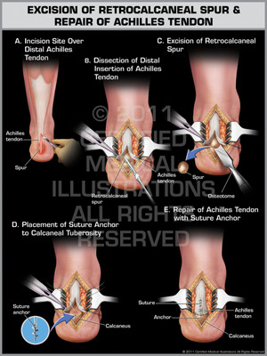 Exhibit of Excision of Retrocalcaneal Spur & Repair of Achilles Tendon. Exhibit of Excision of Retrocalcaneal Spur & Repair of Achilles Tendon.