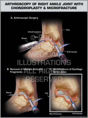 Exhibit of Arthroscopy of Right Ankle Joint with Chondroplasty & Microfracture. Exhibit of Arthroscopy of Right Ankle Joint with Chondroplasty & Microfracture.