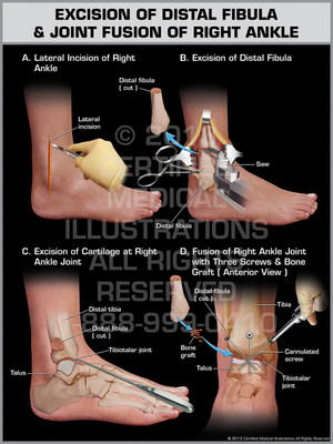 Exhibit of Excision of Distal Fibula & Joint Fusion of Right Ankle.