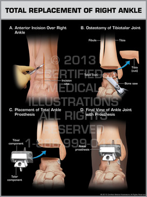 Exhibit of Total Replacement of Right Ankle.