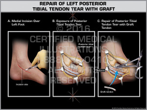 Exhibit of Repair of Left Posterior Tibial Tendon Tear with Graft. Exhibit of Repair of Left Posterior Tibial Tendon Tear with Graft.