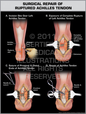 Exhibit of Surgical Repair of Ruptured Achilles Tendon. Exhibit of Surgical Repair of Ruptured Achilles Tendon.