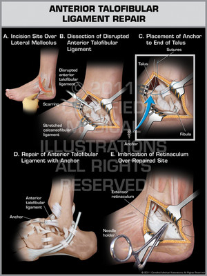 Exhibit of Anterior Talofibular Ligament Repair. Exhibit of Anterior Talofibular Ligament Repair.
