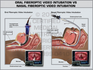 Exhibit of Oral Fiberoptic Video Intubation vs Nasal Fiberoptic Video Intubation. Exhibit of Oral Fiberoptic Video Intubation vs Nasal Fiberoptic Video Intubation.
