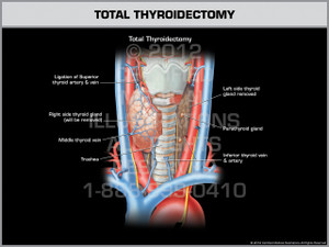 Exhibit of Total Thyroidectomy. Exhibit of Total Thyroidectomy.
