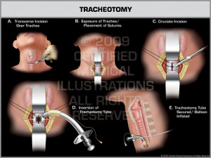 Exhibit of Tracheotomy. Exhibit of Tracheotomy.