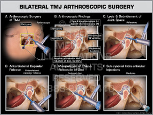Exhibit of Bilateral TMJ Arthroscopic Surgery. Exhibit of Bilateral TMJ Arthroscopic Surgery.
