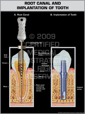 Exhibit of Root Canal and Implantation of Tooth. Exhibit of Root Canal and Implantation of Tooth.