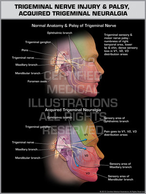 Exhibit of Trigeminal Nerve Injury & Palsy, Acquired Trigeminal Neuralgia. Exhibit of Trigeminal Nerve Injury & Palsy, Acquired Trigeminal Neuralgia.