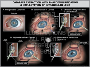 Exhibit of Cataract Extraction with Phacoemulsification & Implantation of Intraocular Lens. Exhibit of Cataract Extraction with Phacoemulsification & Implantation of Intraocular Lens.