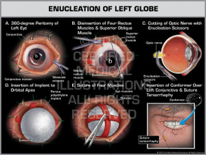 Exhibit of Enucleation of Left Globe. Exhibit of Enucleation of Left Globe.