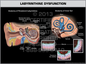 Exhibit of Labyrinthine Dysfunction. Exhibit of Labyrinthine Dysfunction.