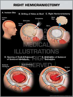 Exhibit of Right Hemicraniectomy. Exhibit of Right Hemicraniectomy.