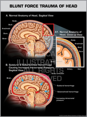 Exhibit of Blunt Force Trauma of Head.