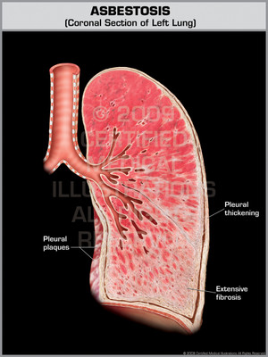 Exhibit of Asbestosis.