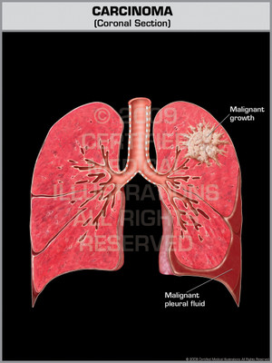 Exhibit of Carcinoma.