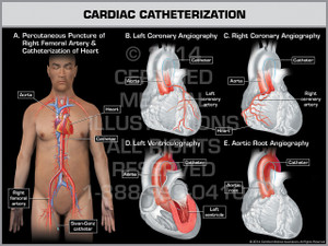 Exhibit of Cardiac Catheterization Male. Exhibit of Cardiac Catheterization Male.