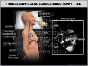 Exhibit of Transesophageal Echocardiography - TEE Female. Exhibit of Transesophageal Echocardiography - TEE Female.