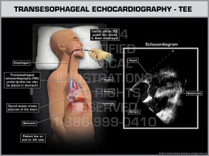 Exhibit of Transesophageal Echocardiography - TEE Male.