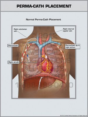 Exhibit of Perma-Cath Placement.