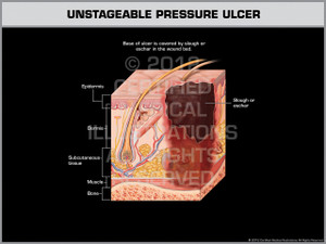 Exhibit of Unstageable Pressure Ulcer. Exhibit of Unstageable Pressure Ulcer.