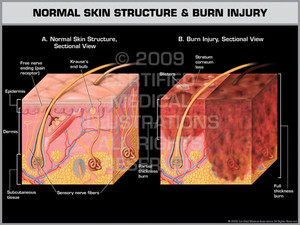 Exhibit of Normal Skin Structure & Burn Injury. Exhibit of Normal Skin Structure & Burn Injury.