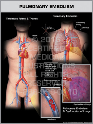 Exhibit of Pulmonary Embolism Male. Exhibit of Pulmonary Embolism Male.