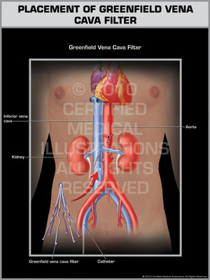 Exhibit of Placement of Greenfield Vena Cava Filter (Male). Exhibit of Placement of Greenfield Vena Cava Filter (Male).