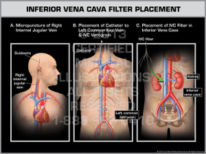 Exhibit of Inferior Vena Cava Filter Placement. Exhibit of Inferior Vena Cava Filter Placement.