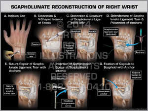 Exhibit of Scapholunate Reconstruction of Right Wrist. Exhibit of Scapholunate Reconstruction of Right Wrist.